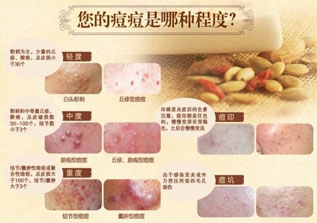 面部痘痘位置揭示身体健康信号全解析