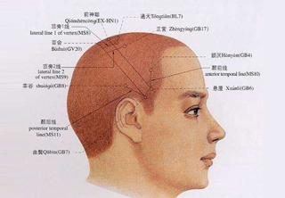 頭皮針
