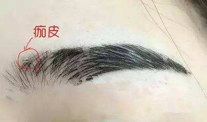 纹绣结痂处理